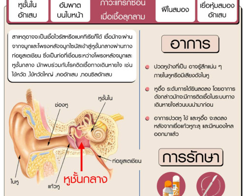 หูชั้นกลางอักเสบเฉียบพลัน ภัยร้ายอันตรายกว่าที่คิด